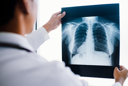 Can You Reverse Bone Loss? What Resistance Training Research Shows